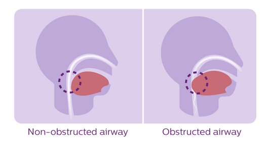 Sleep Apnoea and Reflux: Exploring the Connection