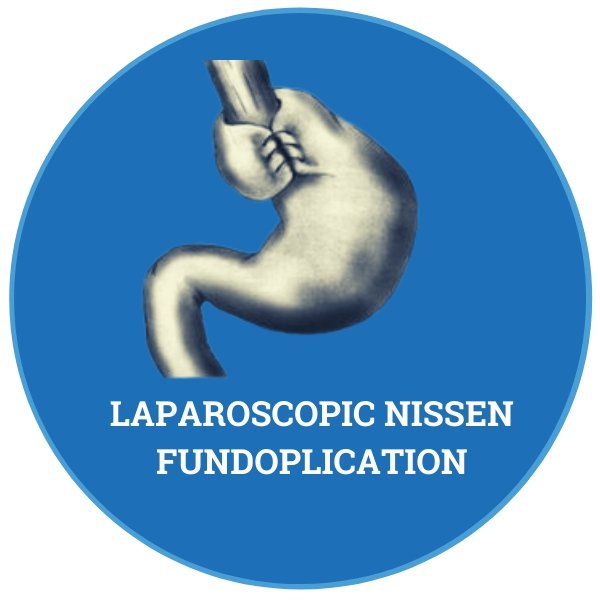 What is Laparoscopic Nissen Fundoplication reflux surgery? - Peptest Australia and New Zealand