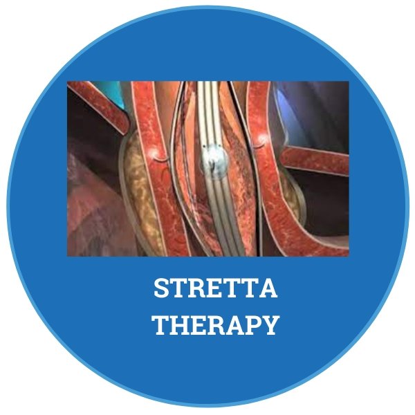 What is Stretta therapy for treating reflux? - Peptest Australia and New Zealand