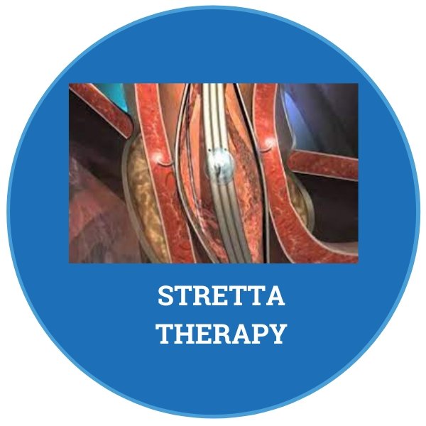 What is Stretta therapy for treating reflux? - Peptest Australia and New Zealand